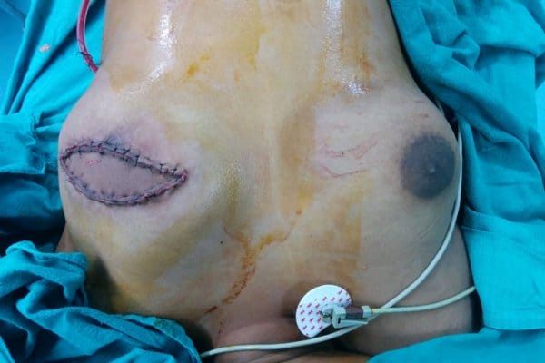 breast surgery in Bhubaneswar