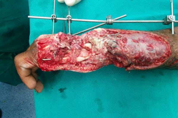 plastic burn surgery in Bhubaneswar