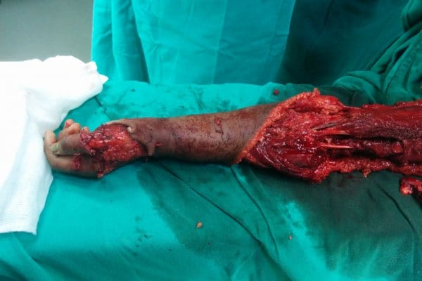 burn surgery in Bhubaneswar