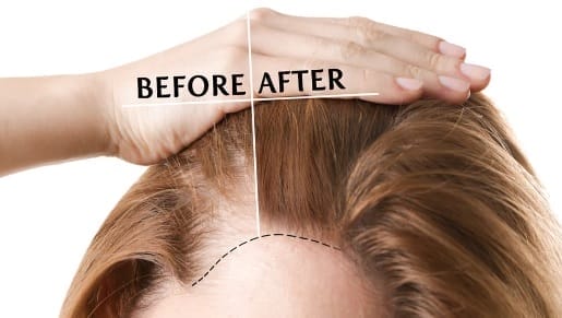 A Comprehensive Guide to Hair Transplant in Bhubaneswar