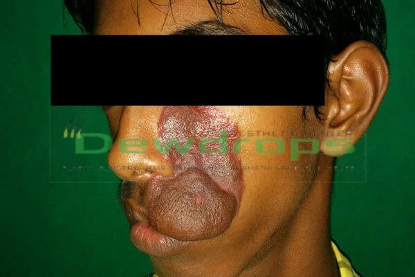 face plastic surgery in Bhubaneswar