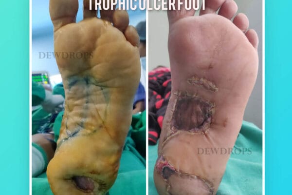 Tropic Ulcer Foot