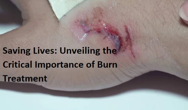 Saving Lives: Unveiling the Critical Importance of Burn Treatment