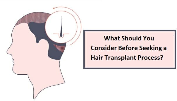 What Should You Consider Before Seeking a Hair Transplant Process?