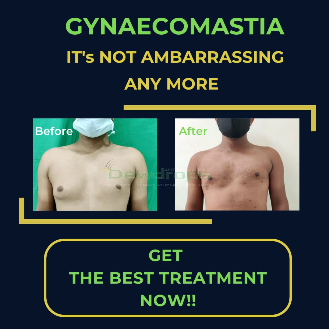 Gynecomastia Surgery (Breast Enlargement in Men) – Shared By Odisha’s Top Plastic Surgeon