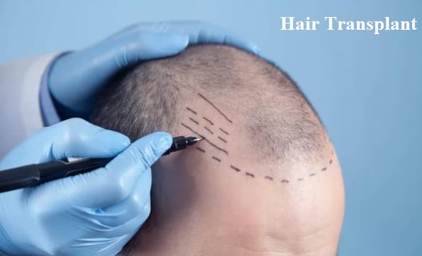 Top 5 Reasons why Hair Transplant can Produce Long Lasting Results